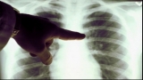 Pacienții infectați cu tuberculoză vor putea fi tratați și în sistem ambulatoriu