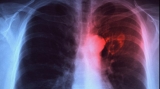 România, fruntașă la tuberculoză