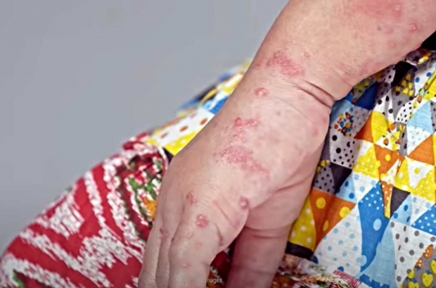 Nou caz de variola maimuței, diagnosticat în România