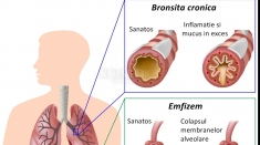 Bronhopneumopatia obstructivă cronică şi probleme ale coloanei 