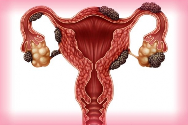 (w640) endometrio